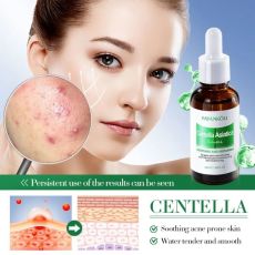 FAYANKOU Сыворотка для лица увлажняющая от прыщей и акне Centella Asiatica, 30мл. Арт.: 4064 Сыворотка от прыщей, препятствует появлению акне и высыпаниям, улучшает тон лица. Регулирует работу сальных